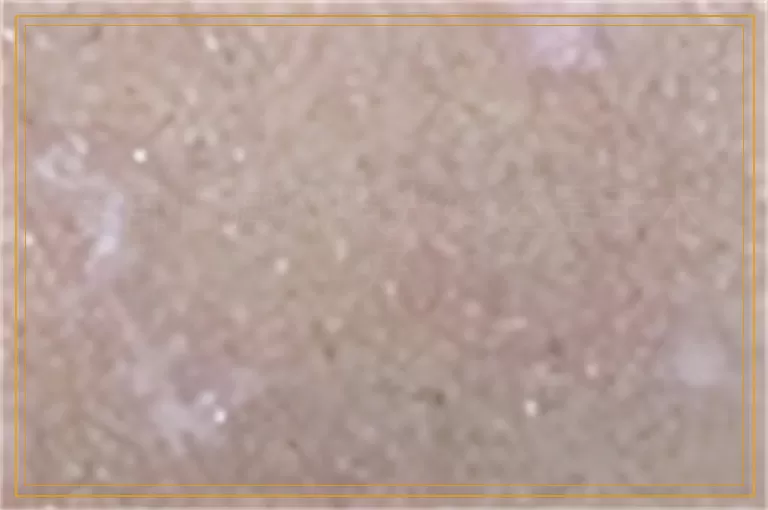 手部白癜风照光好还是手术好