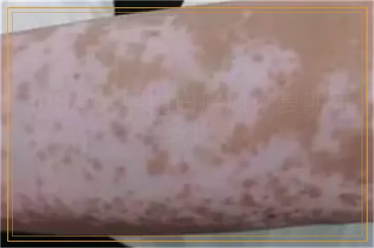 308激光照射白癜风恢复期有多长