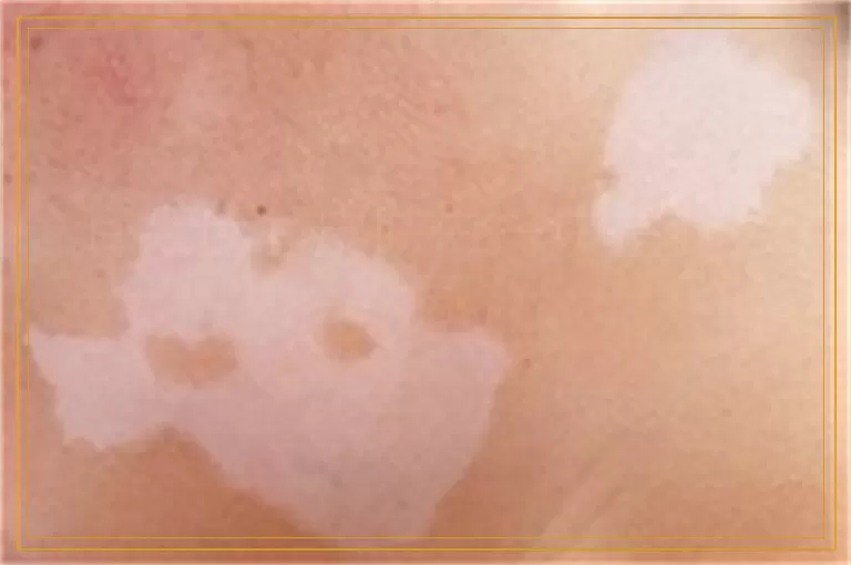 耳朵后面皮肤白一块是什么病