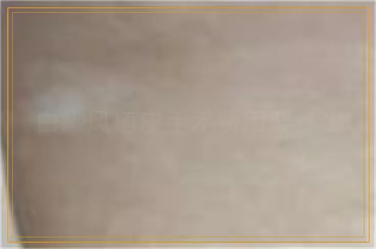 白癜风植皮手术费用要多少