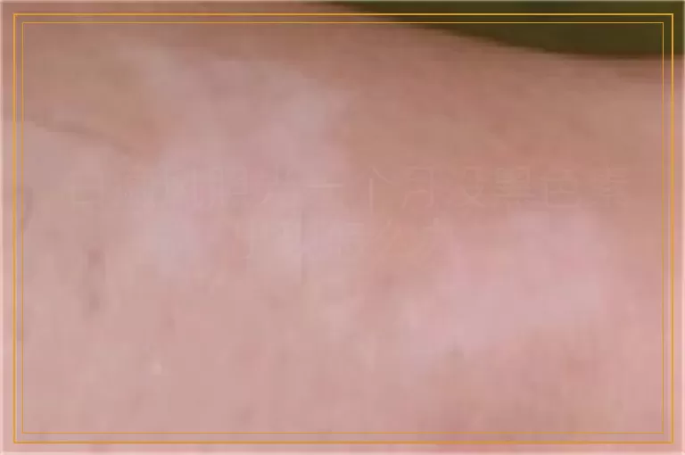 白癜风照光一个月没黑色素出现怎么办