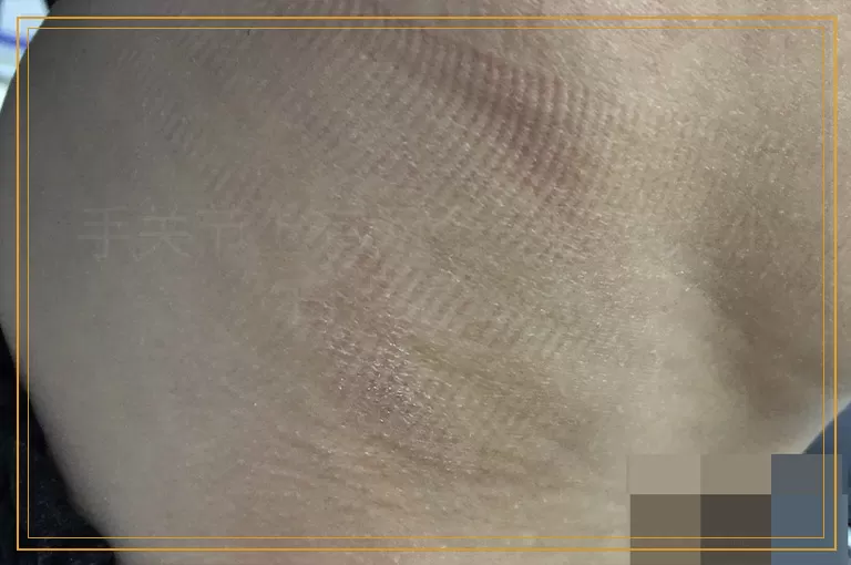 手关节上有两个一厘米大小白点怎么治