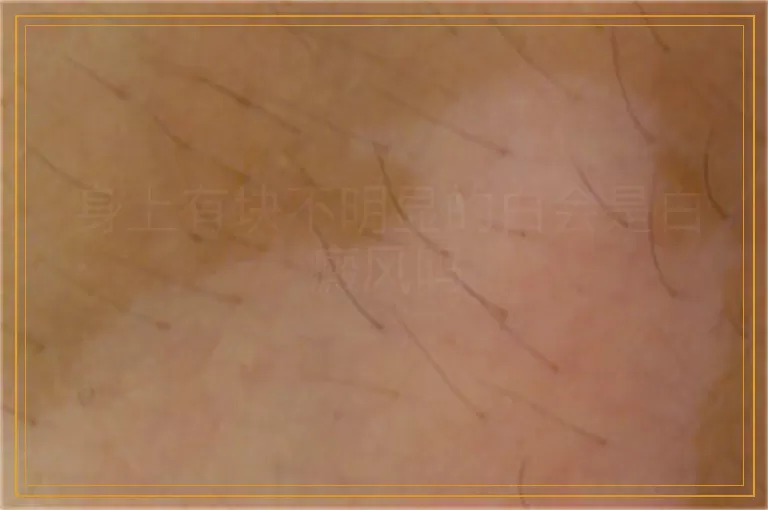 身上有块不明显的白会是白癜风吗