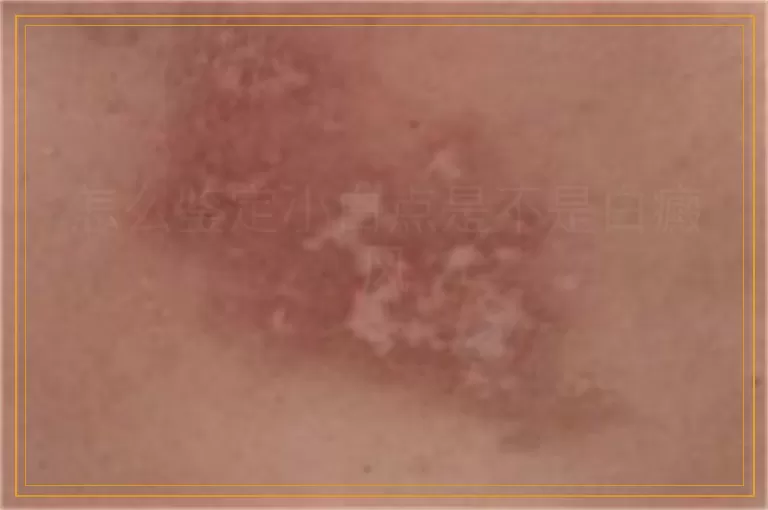 怎么鉴定小白点是不是白癜风