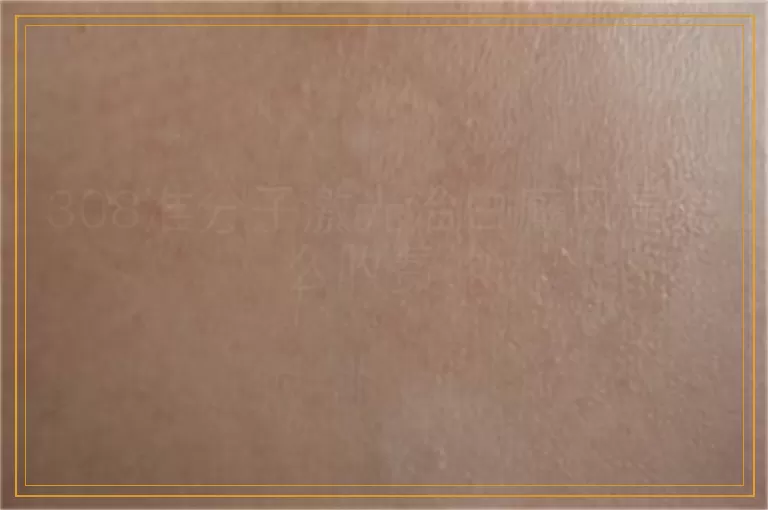 308准分子激光治白癜风是怎么收费的