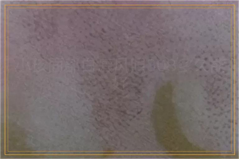 小孩面部白癜风照308多久能好