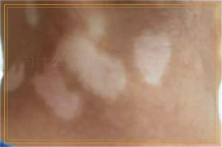 为什么脸上都是白色的小点儿点儿