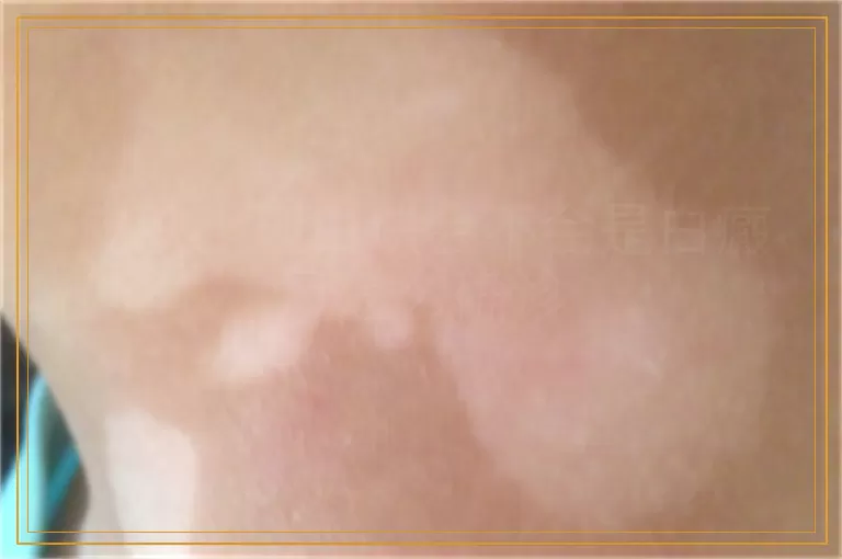 皮肤出现白块会不会是白癜风怎么确诊
