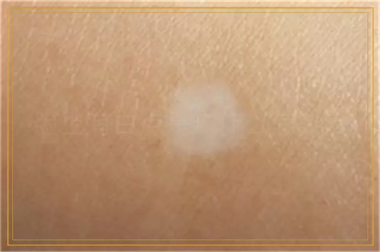 脸上有白点是缺什么怎么治