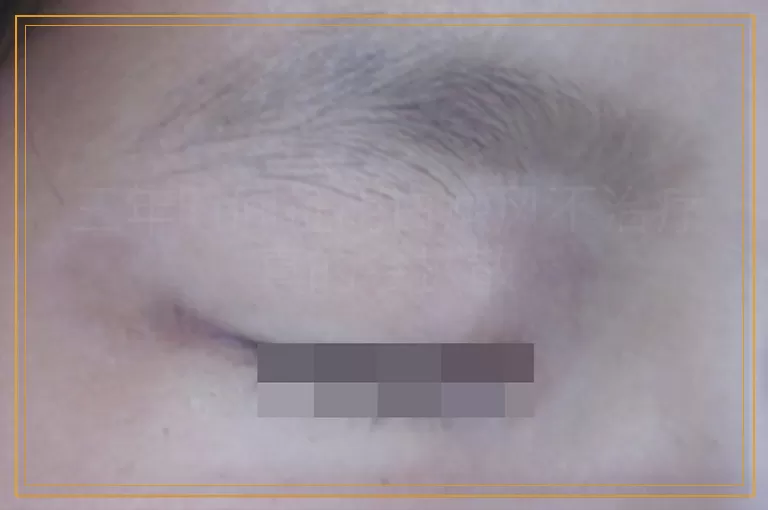 三年时间证明白癜风不治疗真的会扩散