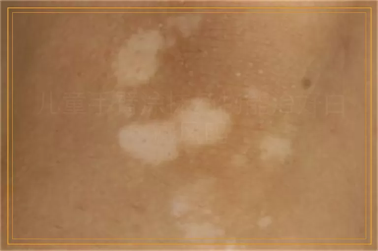 儿童手臂涂抹药物能治好白癜风吗