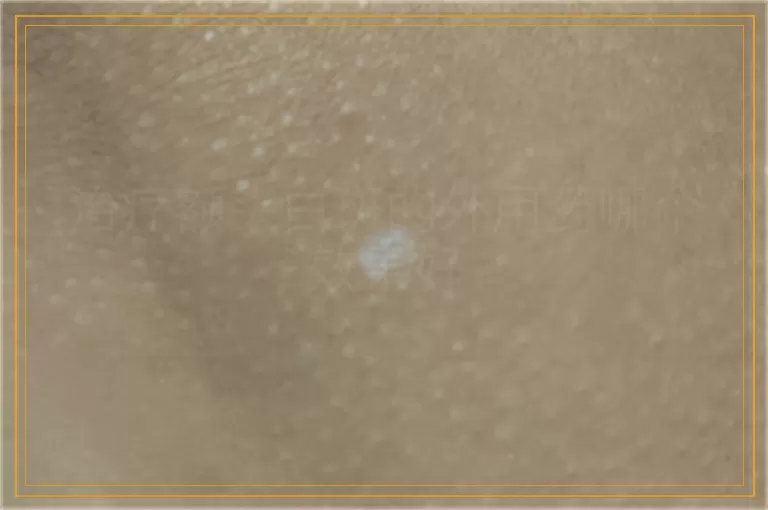 治疗额头白斑的外用药哪个效果好