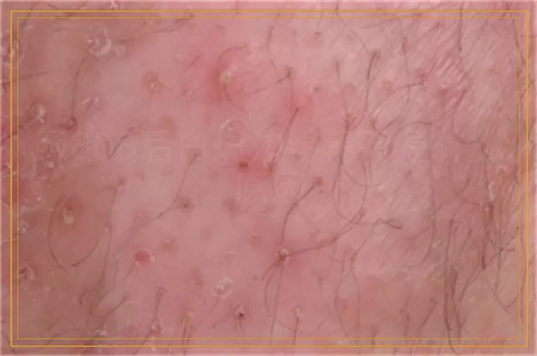 照308后白斑边缘黑了是什么原因