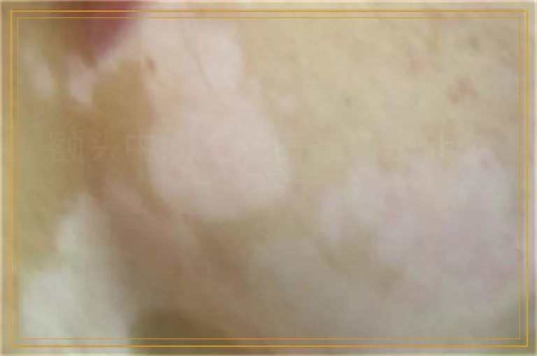 额头中间皮肤白一块是什么病