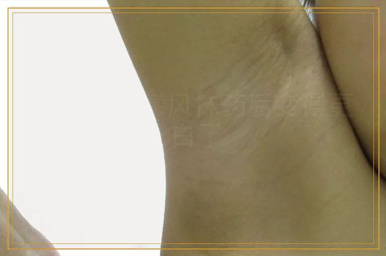 为什么白癜风抹药后变得更白了