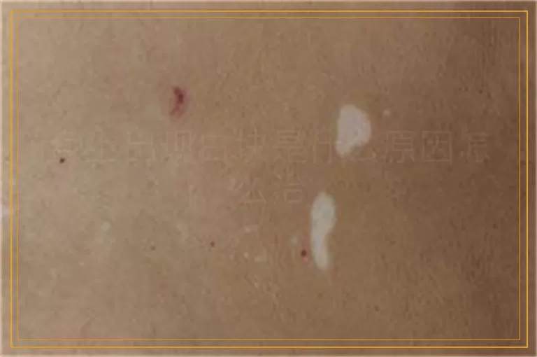 身上出现白块是什么原因怎么治
