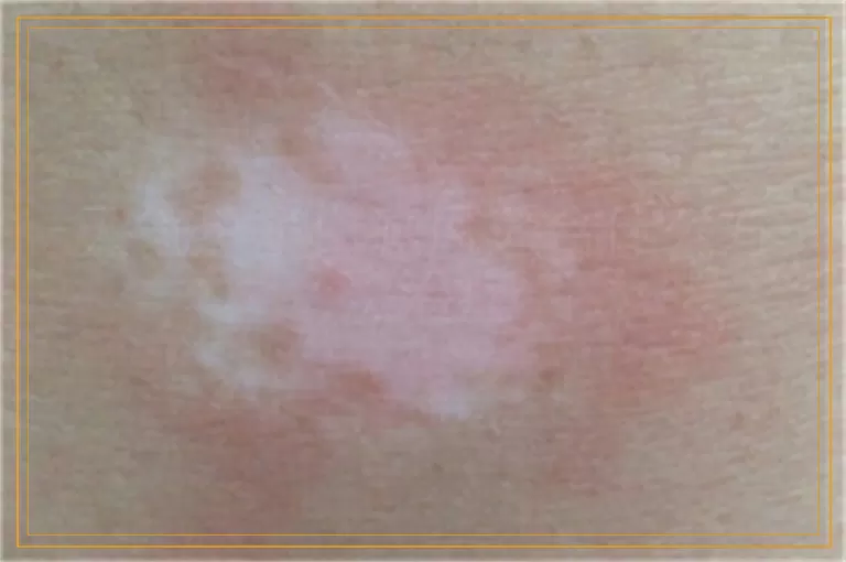 天气热了白癜风适合什么方法治疗