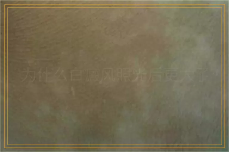 为什么白癜风照光后更大了
