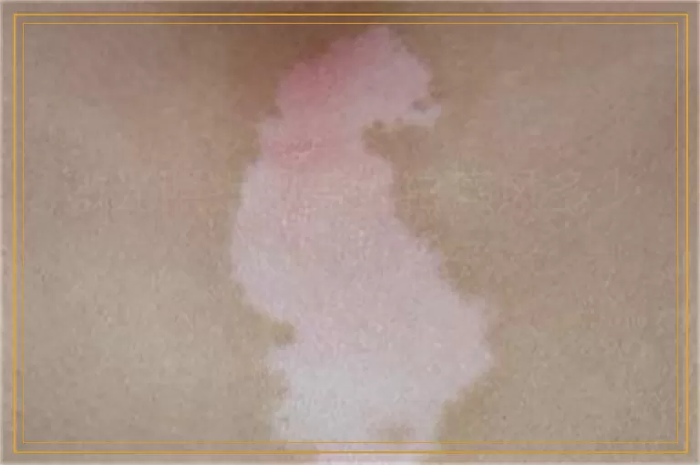 激光照指甲盖大白癜风多少钱