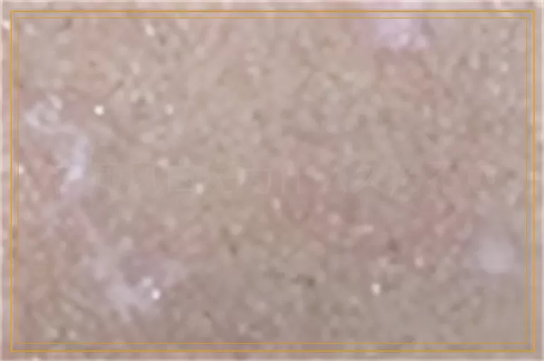 白癜风白斑为什么久治不愈