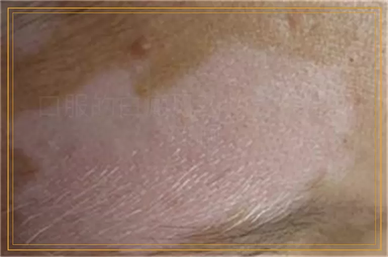 口服的白癜风药物多久能见效啊