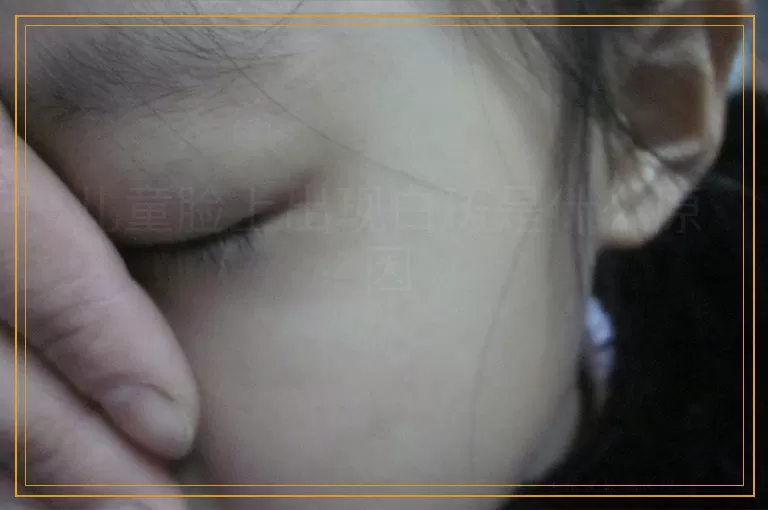 儿童脸上出现白斑是什么原因