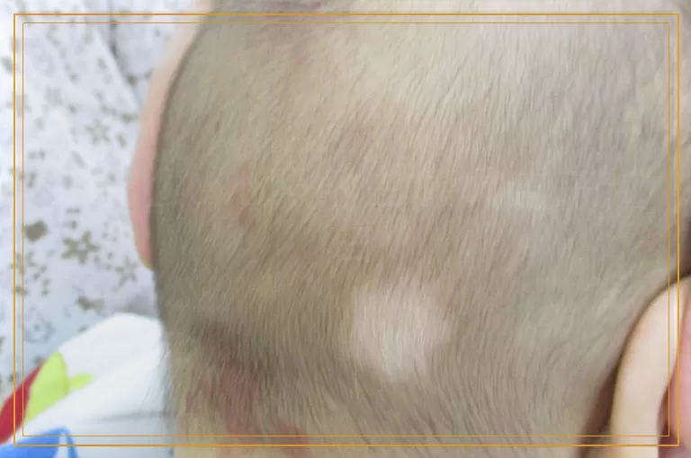 为什么uvb照射白癜风越来越白