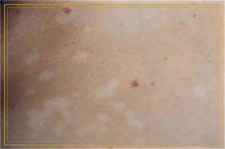 几十年的白斑没有扩散该怎么治疗