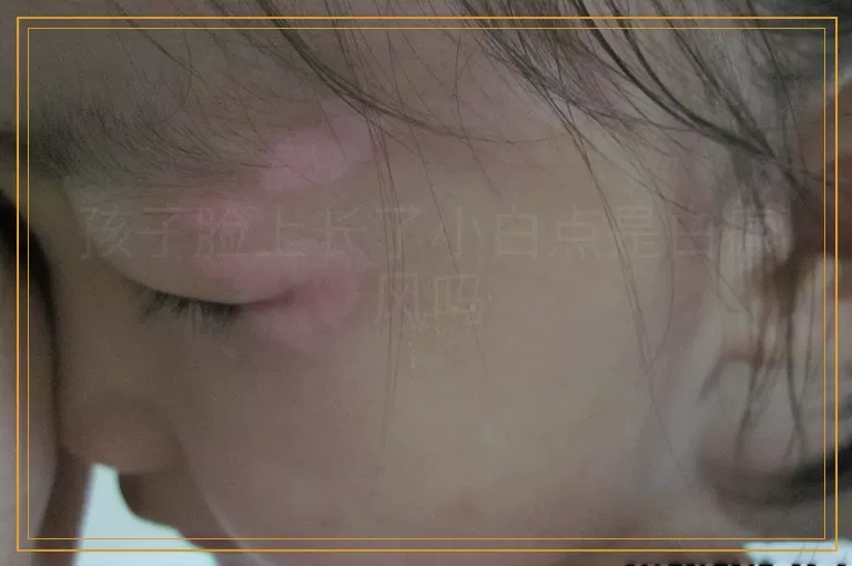 孩子脸上长了小白点是白癜风吗