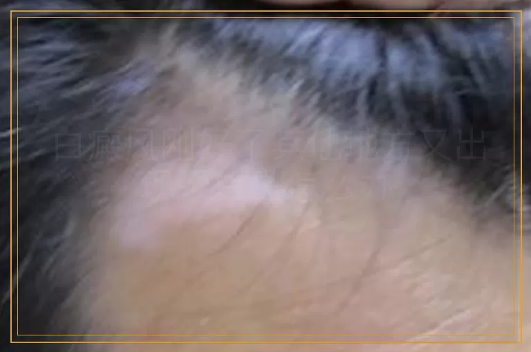 白癜风刚好了其他地方又出现了白斑怎么办