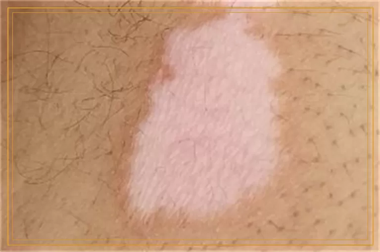 伍德灯诊断白斑呈白色是白癜风吗