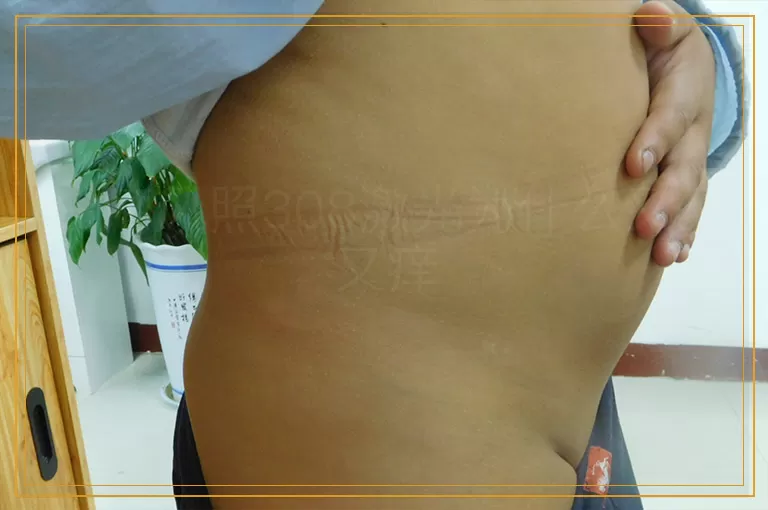 白癜风照308激光为什么又红又痒