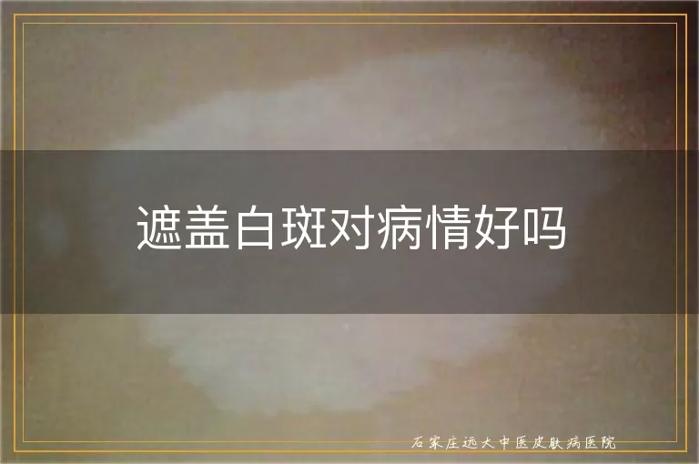 遮盖白斑对病情好吗