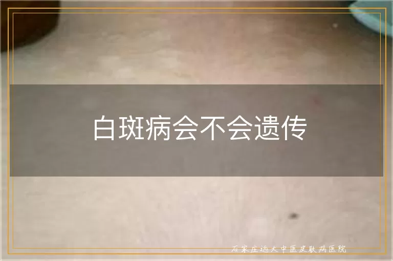 白斑病会不会遗传