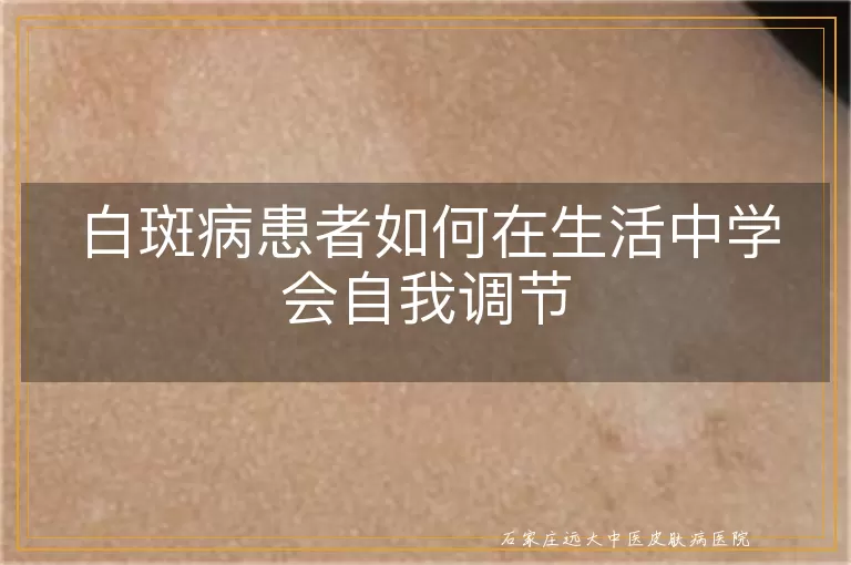 白斑病患者如何在生活中学会自我调节