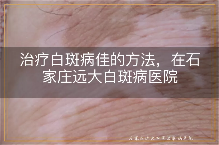 治疗白斑病佳的方法，在石家庄远大白斑病医院