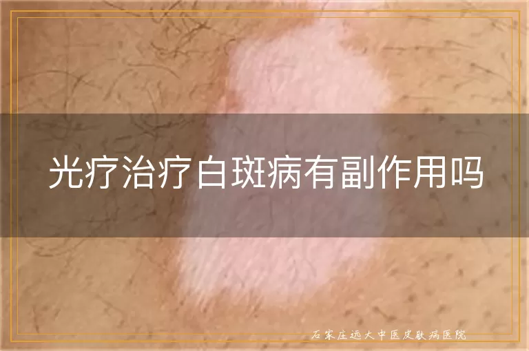 光疗治疗白斑病有副作用吗