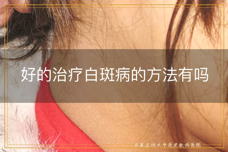 好的治疗白斑病的方法有吗