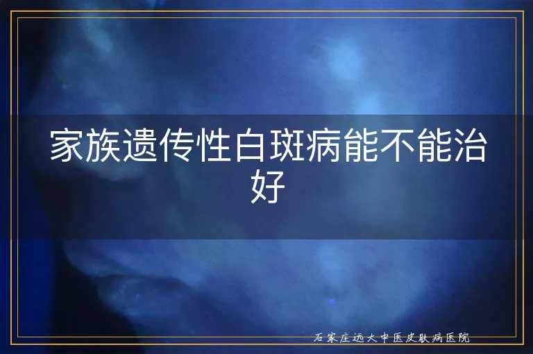家族遗传性白斑病能不能治好