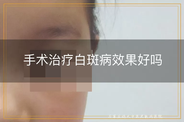手术治疗白斑病效果好吗