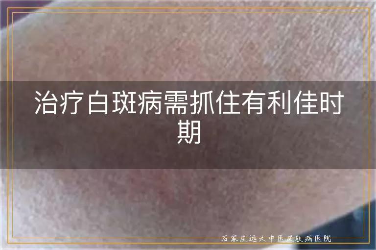 治疗白斑病需抓住有利佳时期