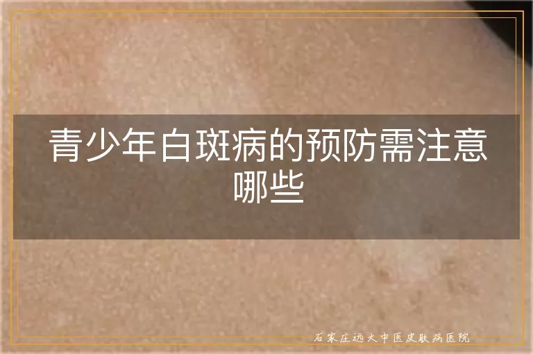 青少年白斑病的预防需注意哪些