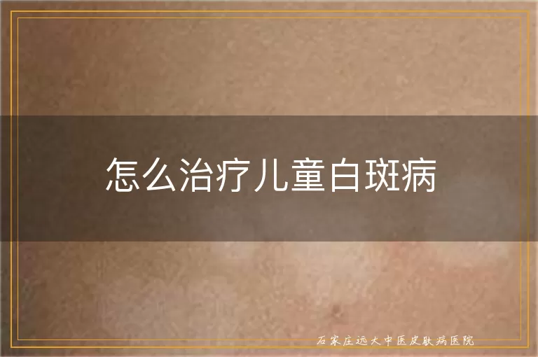 怎么治疗儿童白斑病