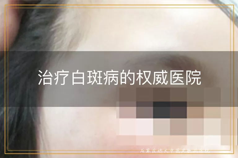 治疗白斑病的权威医院