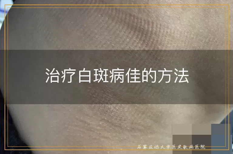 治疗白斑病佳的方法