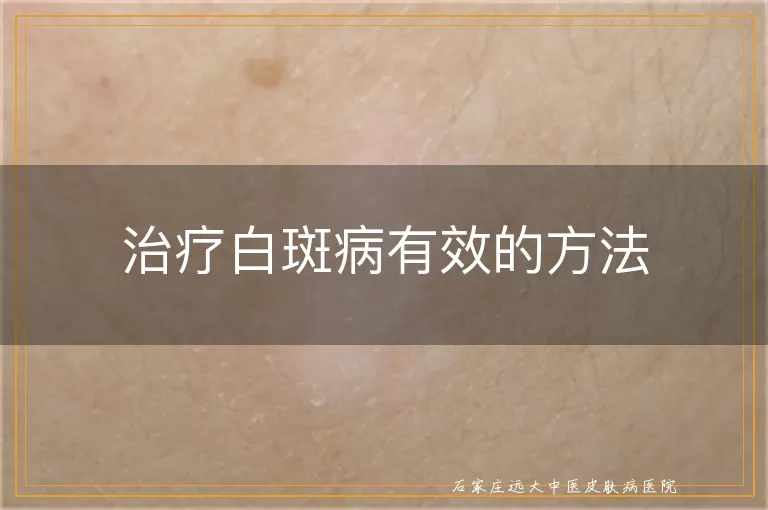 治疗白斑病有效的方法