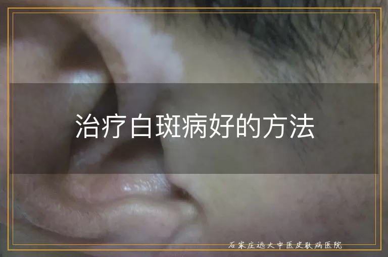 治疗白斑病好的方法