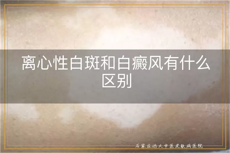 离心性白斑和白癜风有什么区别