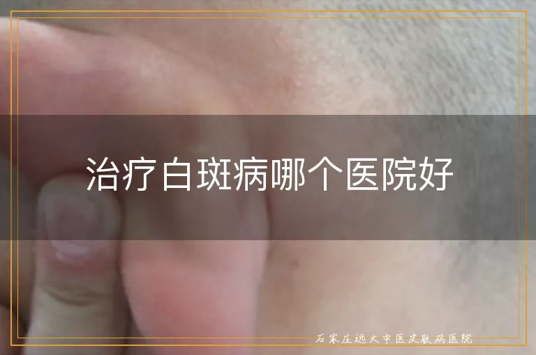 治疗白斑病哪个医院好