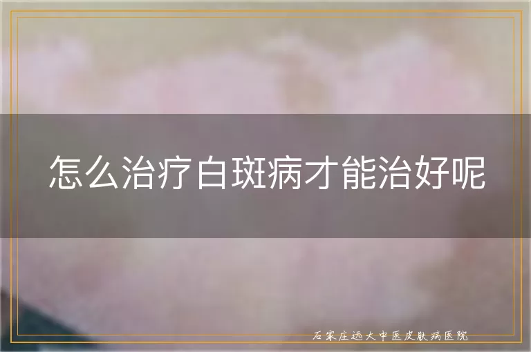 怎么治疗白斑病才能治好呢